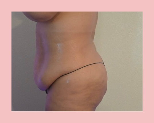 Lymphatic Drainage + Cavitation — One Session after