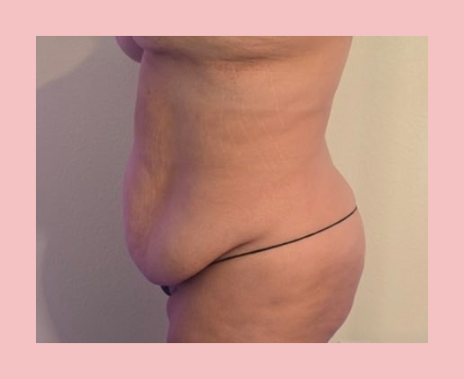 Lymphatic Drainage + Cavitation — One Session before
