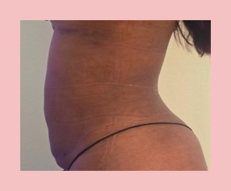Post-Op Lymphatic Drainage Massage — 4th Session before