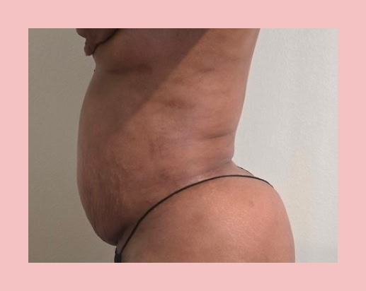 Post-Op Lymphatic Drainage with Cavitation — Scar Tissue Treatment before