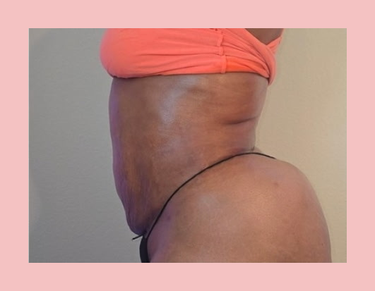 Post-Op Lymphatic Drainage with Cavitation — Scar Tissue Treatment after