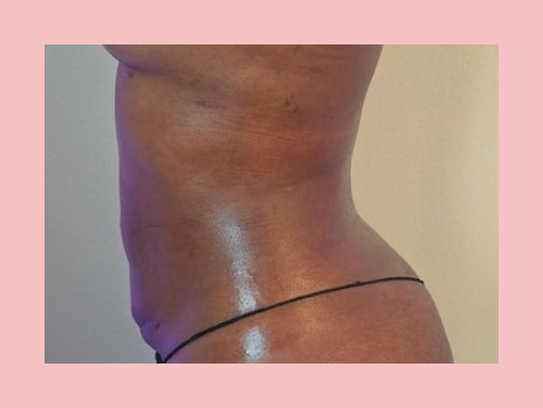 Post-Op Lymphatic Drainage Massage — 4th Session after