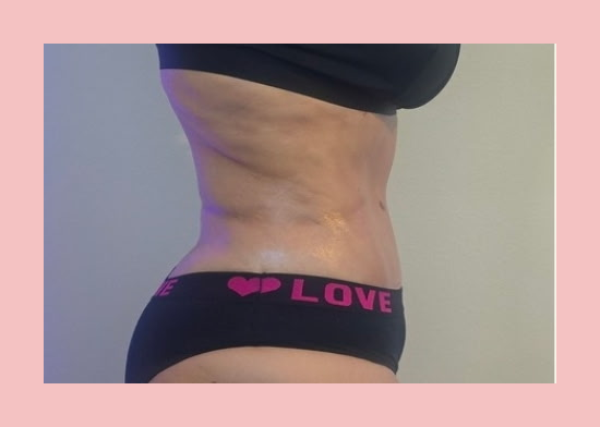 Post-Op Lymphatic Drainage Maintenance Massage with Sauna Wrap before